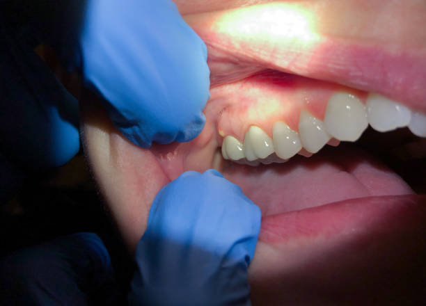 Best After-Hours Dental Trauma Care in Woodsville, NH