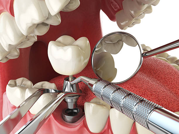 Best Emergency Treatment for Dental Infections or Abscesses in Woodsville, NH