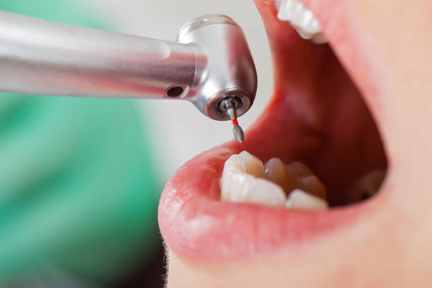 Best Emergency Tooth Extraction in Woodsville, NH